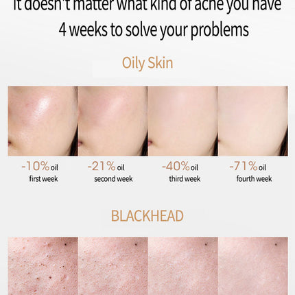 Acne Removing Salicylate Serum