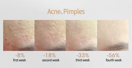 Acne Removing Salicylate Serum